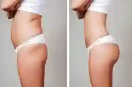 أفضل شفط دهون في دبي وأبو ظبي