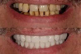 خلع الاسنان في ابوظبي