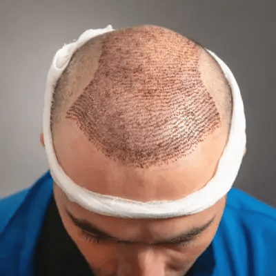 زراعة الشعر بطريقة FUE في دبي الإمارات العربية المتحدة