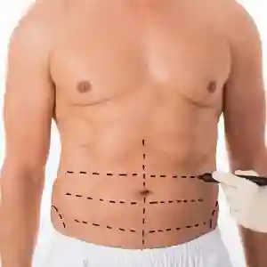 شفط الدهون في دبي نتائج مضمونة وجسم منحوت