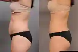 شفط الدهون في دبي