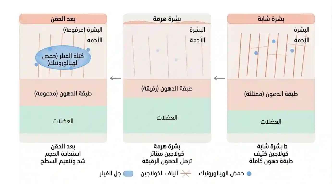 كيف يدفع فقدان الكولاجين الطلب على الحشوات مقطع عرضي لبشرة الشيخوخة