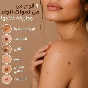 6 أنواع من النموات الجلدية وكيفية علاجها