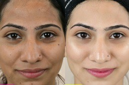 Full Body Skin Lightening Surgery Cost in Dubai