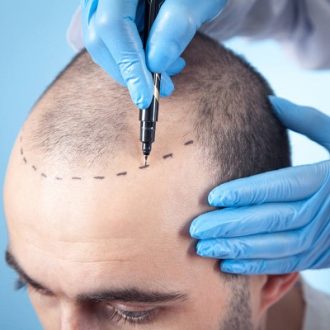 Hair Transplant in Dubai For 1 Dirham