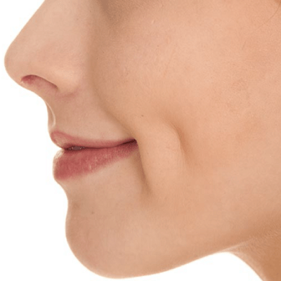 Dimple Creation Surgery in Dubai & Abu Dhabi - Dimpleplasty