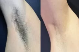 Best Laser Hair Removal Cost Clinic in Dubai