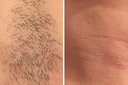 Best Laser Hair Removal Cost in Dubai