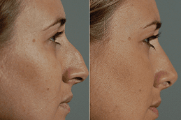 Best Rhinoplasty Cost Clinic in Dubai