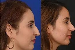 Best Rhinoplasty Cost in Dubai