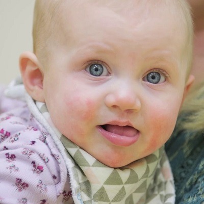 Cleft Lip and Palate Surgery in Dubai & Abu Dhabi