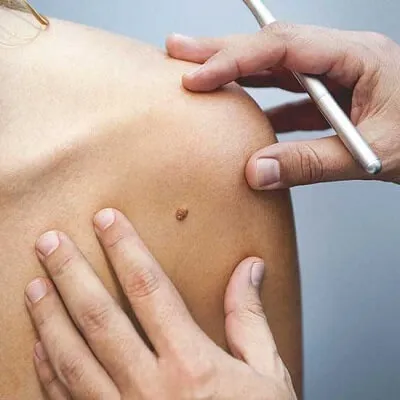 Mole Removal In Dubai & Abu Dhabi | Cost, Laser & Surgical Options