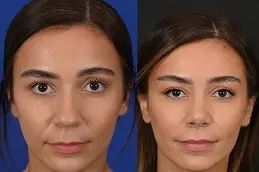 Rhinoplasty Cost in Dubai