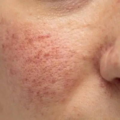 Rosacea Treatment in Dubai & Abu Dhabi