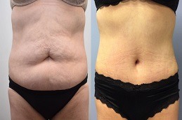 Lipolysis Injection Dubai Before & After