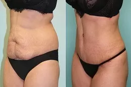 Lipolysis Injection Before & After