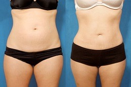 Lipolysis Injection in Dubai Before & After