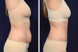 Before & After Lipolysis Injection