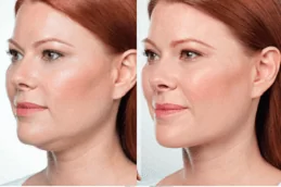 Belkyra Treatment in Dubai