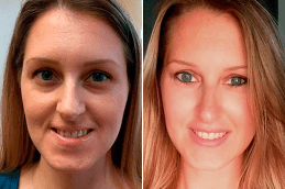 Belotero Fillers Clinic in Dubai