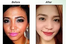 Tationil Glutathione Injection In Dubai & Abu Dhabi