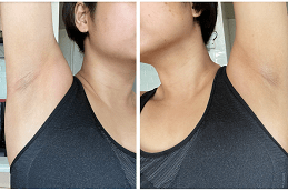 Best Clinic of The Ordinary Peeling Solution for Underarms Dubai