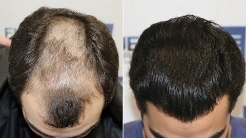 Best Hair Transplant in Dubai UAE