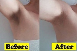 Best The Ordinary Peeling Solution for Underarms Dubai