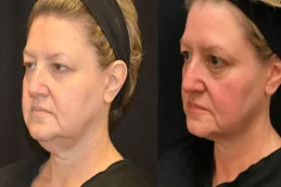Kybella Treatment For Double Chin Abu Dhabi