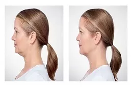 Kybella Treatment For Double Chin Dubai