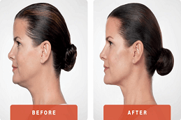 Kybella Treatment For Double Chin in Dubai