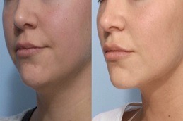 Kybella Treatment For Double Chin