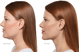 Kybella Treatment For Double Chin