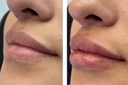 Lip Fillers Injections Clinic in dubai
