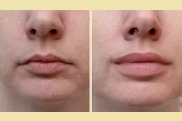 Lip Fillers Injections dubai & abu Dhabi