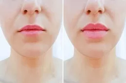 Lip Fillers Injections