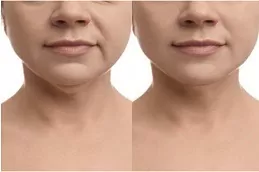 Nefertiti Lift For Jawline Dubai