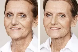 Nefertiti Lift For Jawline in Dubai & Abu Dhabi