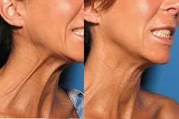 Nefertiti Lift For Jawline in Dubai