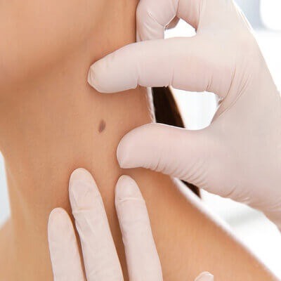 Skin Lession Removal in Dubai