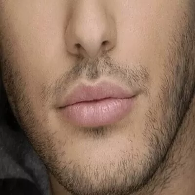 Smoker's Lips Treatment in Dubai UAE & Abu Dhabi