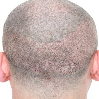 Turkish Hair Transplant in Dubai UAE