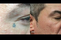 eyebrow-tattoo-removal in dubai