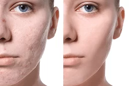 Acne Scar Removal Treatment Dubai