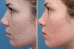 Acne Scar Treatment in Dubai & Abu Dhabi