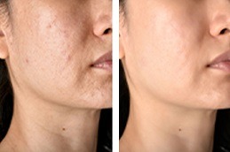 Acne Scars Clinic in Dubai & Abu Dhabi
