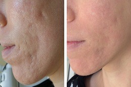 Acne Scars Removal in Dubai & Abu Dhabi