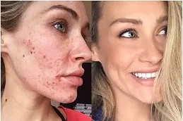 Acne Scars Treatment in UAE Dubai