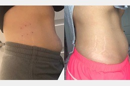 Before & After Lipolysis Injection Dubai