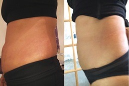 Before & After Lipolysis Injection in Dubai